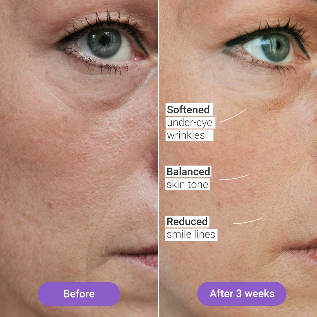 Lumi Light Therapy Mask