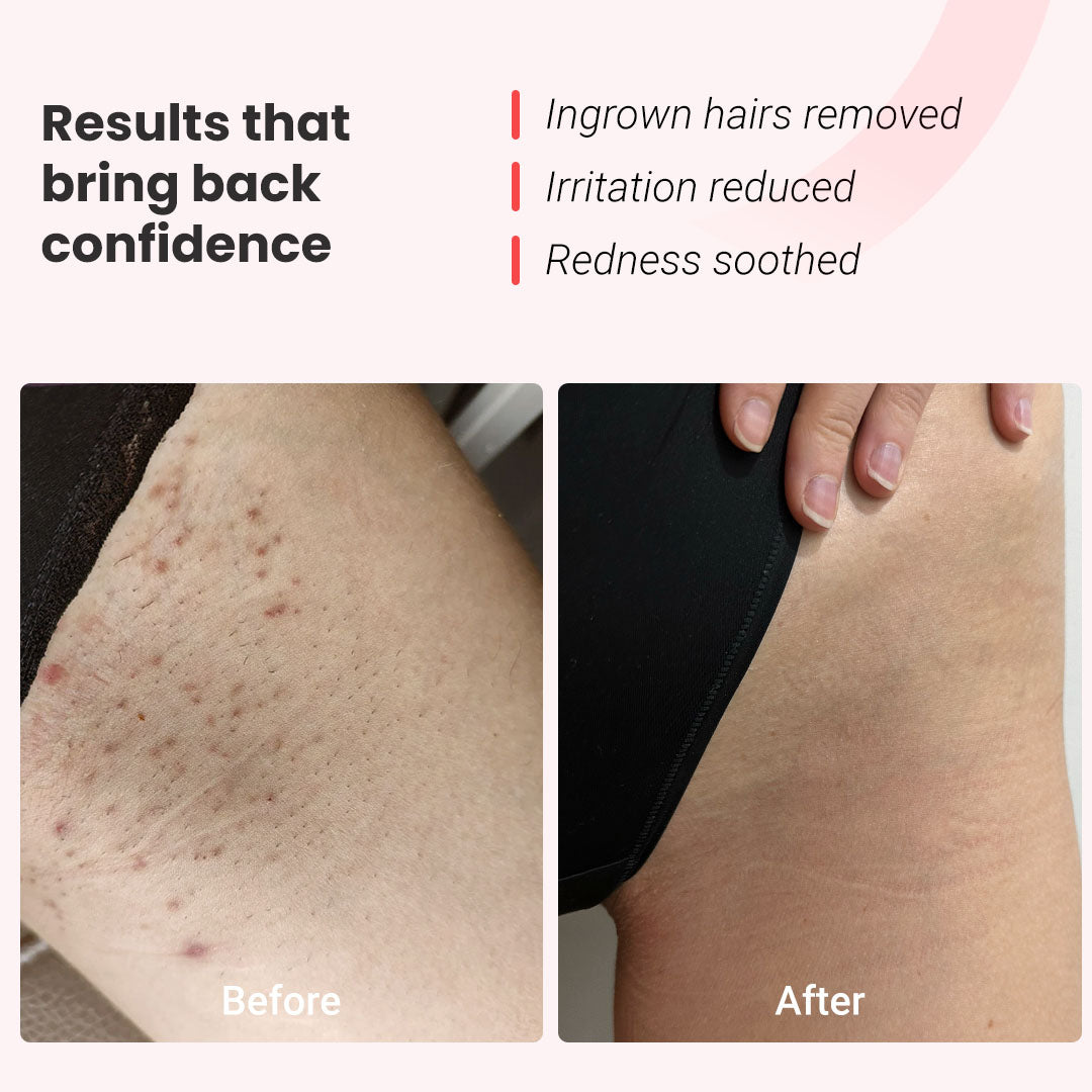 Permanent hair removal device