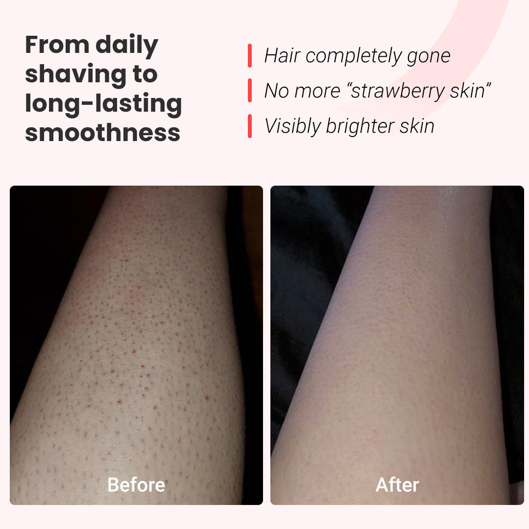 Permanent hair removal device